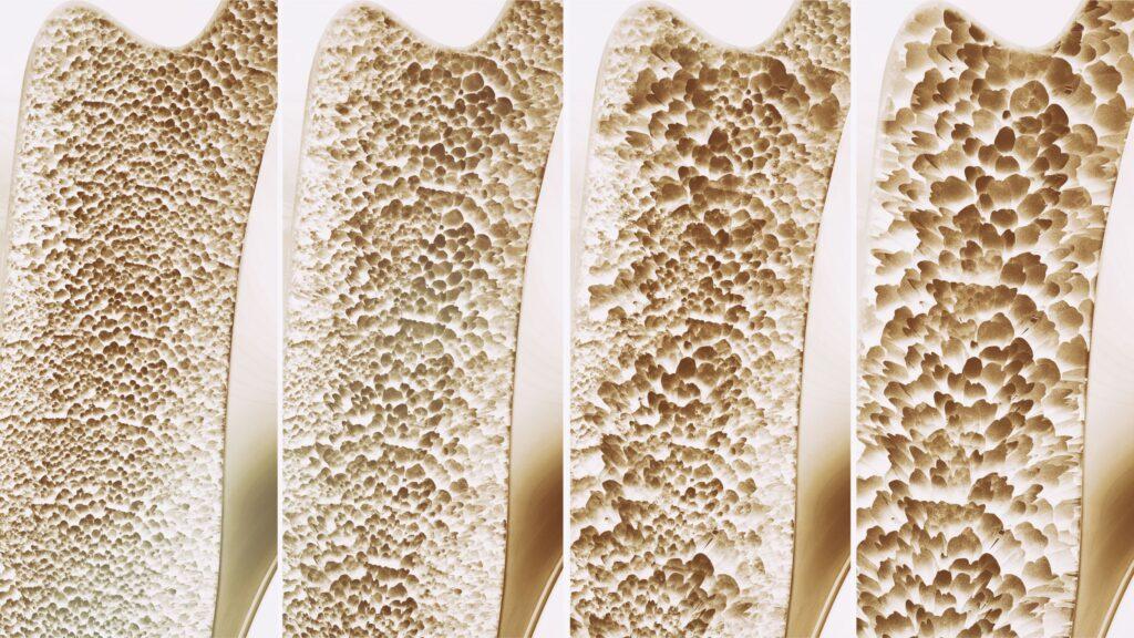 Osteoporosis and Osteopenia: Facts about your bone health you should know