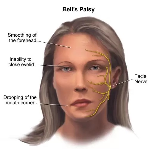 Recovery Journey of a Bell’s Palsy Patient